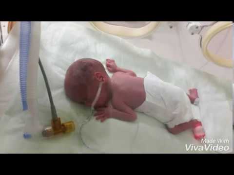 26 haftalık doğan prematüre bebeğin ilk dakikaları. - 26 weeks premature baby after childbirth