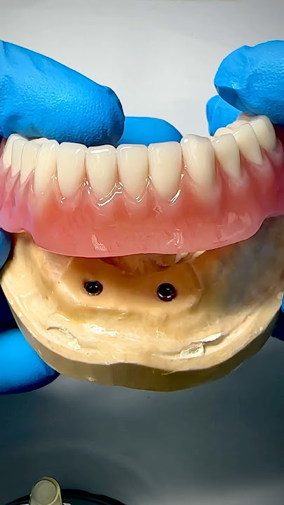 This beautiful hybrid denture was just completed in my lab for Dr. Umair Waheed in Michigan