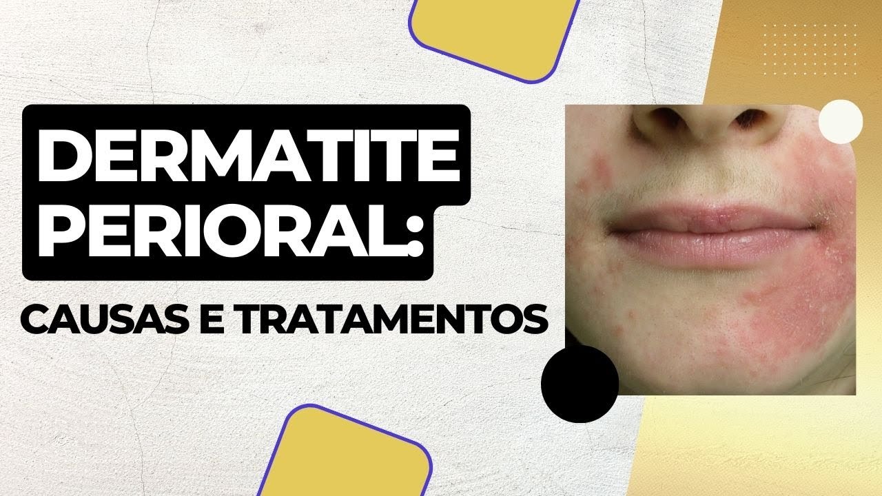 Dermatite perioral: Causas e tratamento