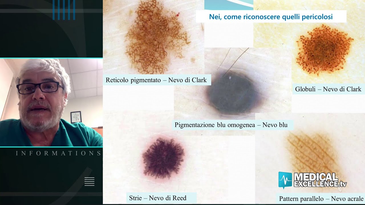 Nei, come riconoscere quelli pericolosi