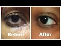 How I corrected my saggy  hooded eyelid (without surgery)