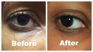 eye cream for sagging eyelids