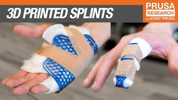Emergency 3D printed splints guide
