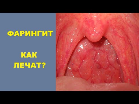 Фарингит. Как лечат врачи?