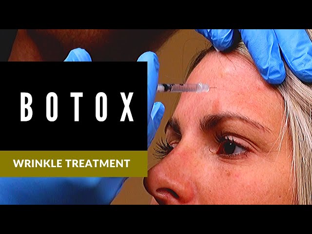 BOTOX Injections to Forehead and Crows Feet | What To Expect | Wrinkle Prevention | Dr. Young