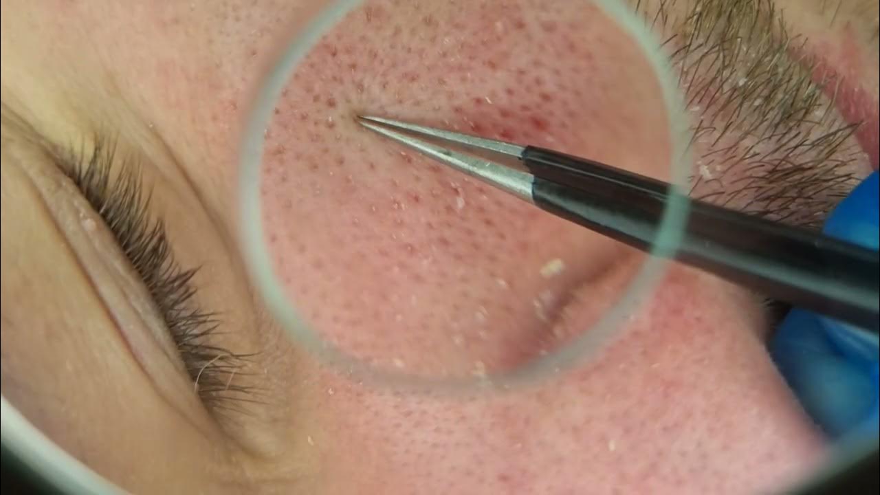 Remove blackheads tweezer YouTube