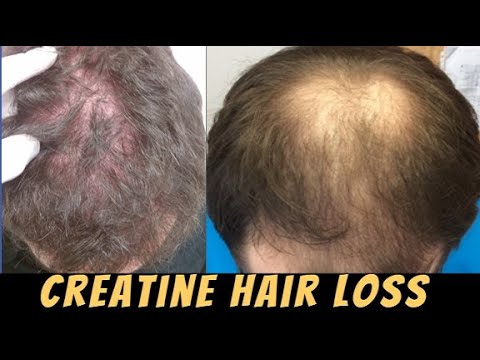 Does Creatine Cause Hair Loss? - YouTube