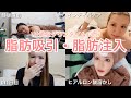 【整形】脂肪吸引して脂肪注入しました!!!💉