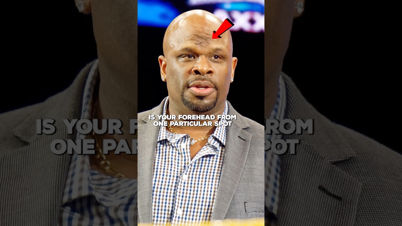 D Von Dudley's Facial Scars From ECW