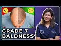 Grade 7 baldness best hair transplant strategy guide