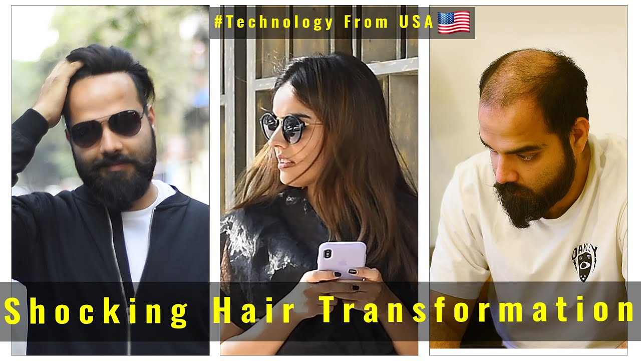 Non Surgical Hair Replacement - Hair Patch/Wigs For Men In India