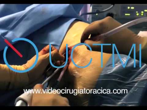 VATS lobectomy by uniportal approach. www.videothoracoscopy.com video editing software free