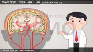 [For demonstration] a0062aako Concept and treatment of Moyamoya disease in children