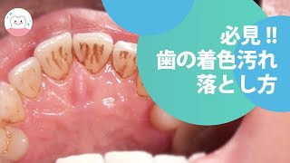 気になる着色汚れを落とす!!エアフロー Remove Stains On Teeth! Air-Flow