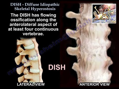 DISH Diffuse Idiopathic Skeletal Hyperostosis - Everything You Need To Know - Dr. Nabil Ebraheim