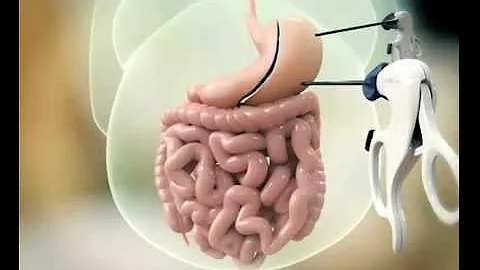 Quanto dura l'intervento di sleeve gastrectomy?