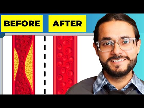 How To Prevent Heart Attack (unclog Your Arteries)