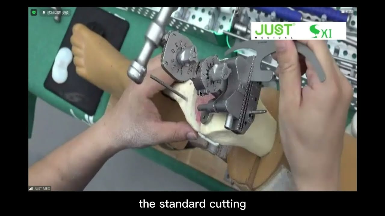 Just Medical SKI Total Knee Replacement Surgical Operation Of The Latest Instruments