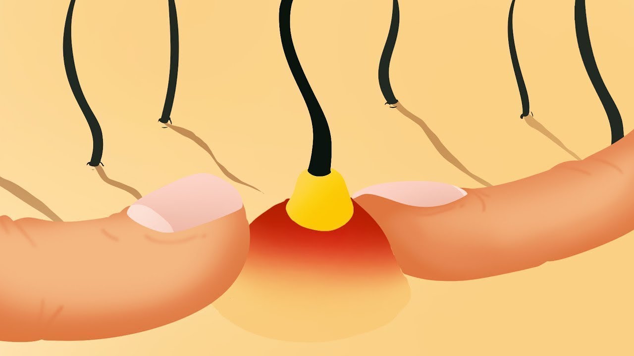 De Quoi Est Composé un Bouton ? Ne L’explose Jamais !