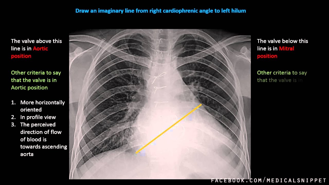 Prosthetic Valve Position In Cxr Youtube