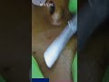 Dermaplaning Face Part 11
