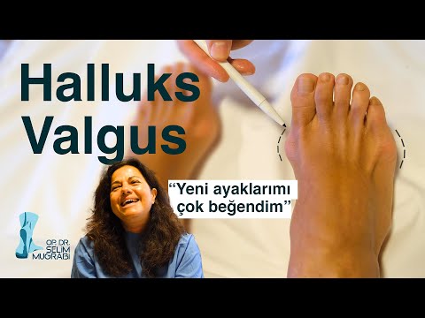 Yeni Ayaklarımı Çok Beğendim! (Halluks Valgus Ameliyatı)  / Op. Dr. Selim Muğrabi