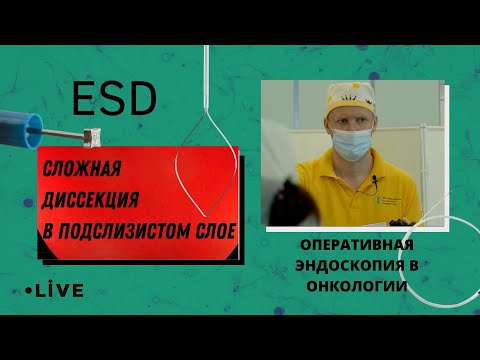Прямая трансляция из НМИЦ онкологии имени Н.Н. Петрова. Диссекция в подслизистом слое