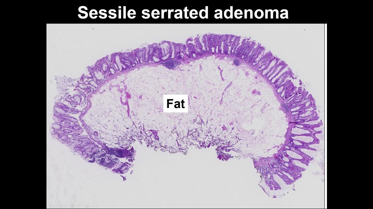 Serrated polyps learn to tell the difference between hyperplastic polyp