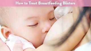 How To Treat Breastfeeding Blisters Cloudmom