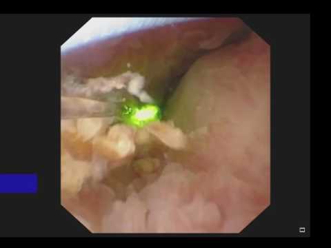 endoscopia renal