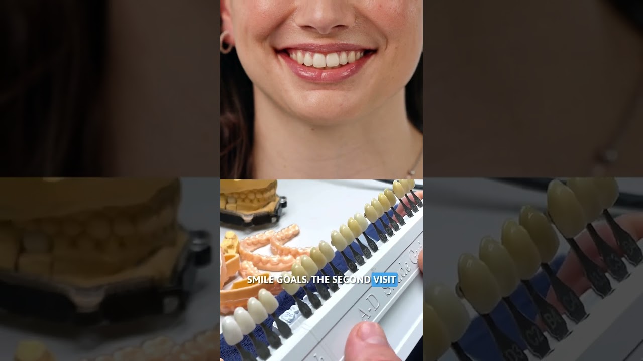 How Long Do Veneers Take? 😁⏰