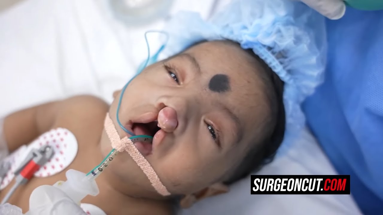Amazing Result And Fast Recovery After Rare Cleft Lip Surgery In India