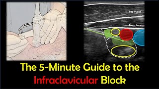 Infraclavicular Brachial Plexus Block - a 