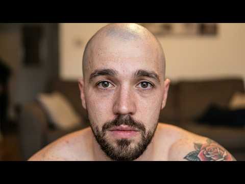 how i went bald in my 20's