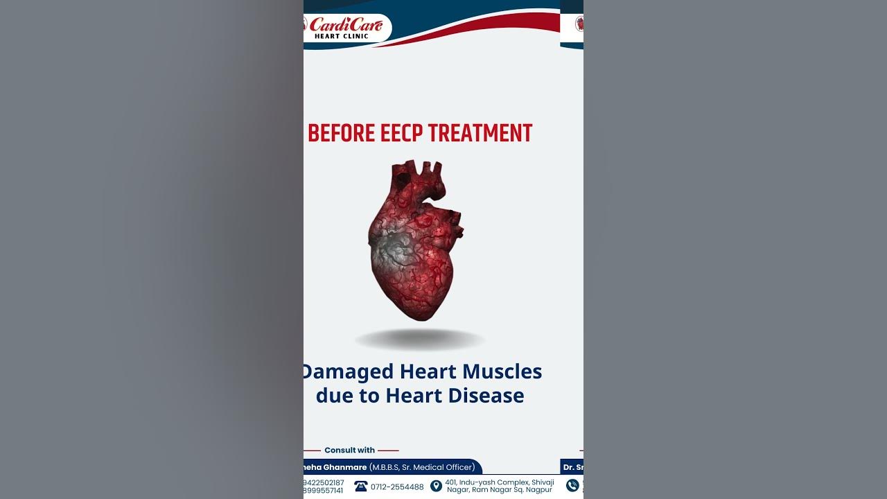 Before and After EECP Treatment NonSurgical Heart Blockage Treatment