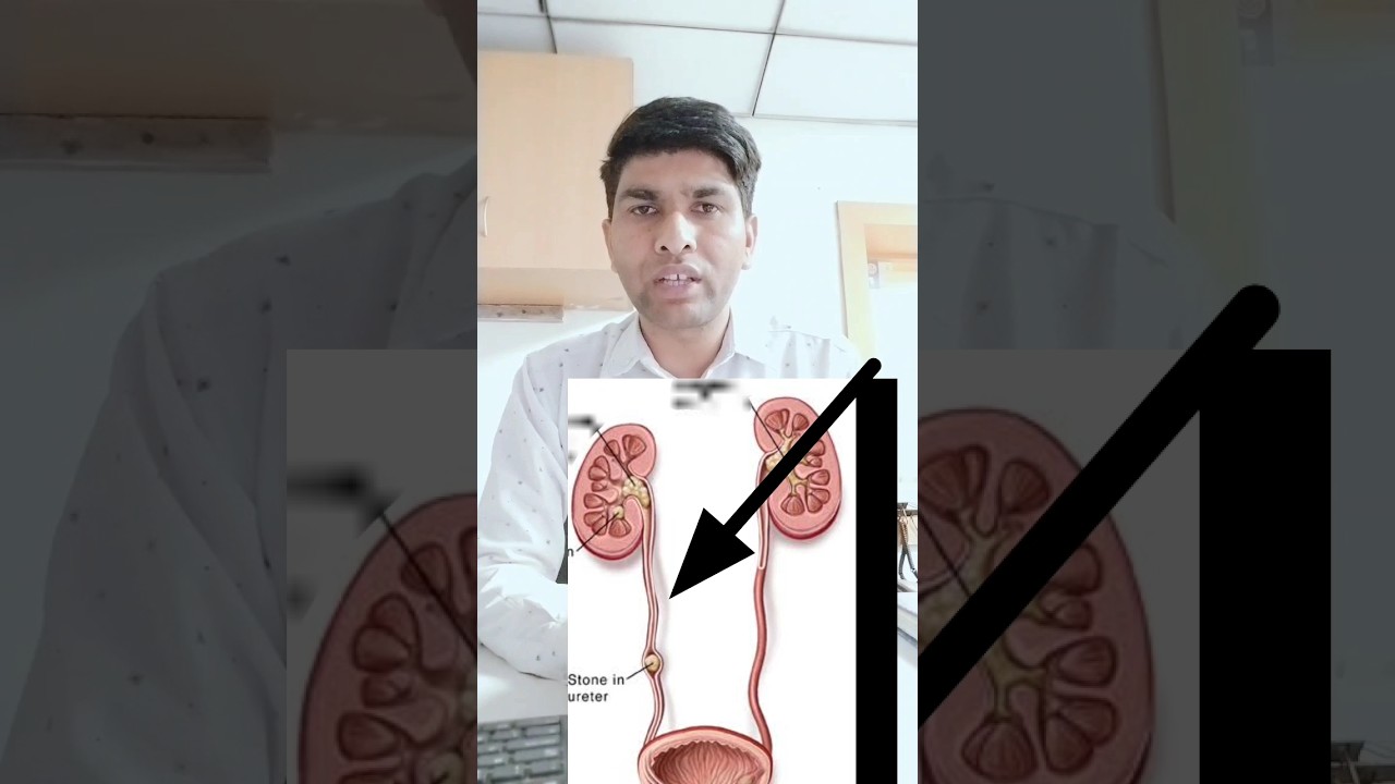 What is Hydronephrosis, Causes of Hydronephrosis 