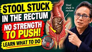 Stool STUCK in the Rectum! What is it and what to do – Doctor Reveals!
