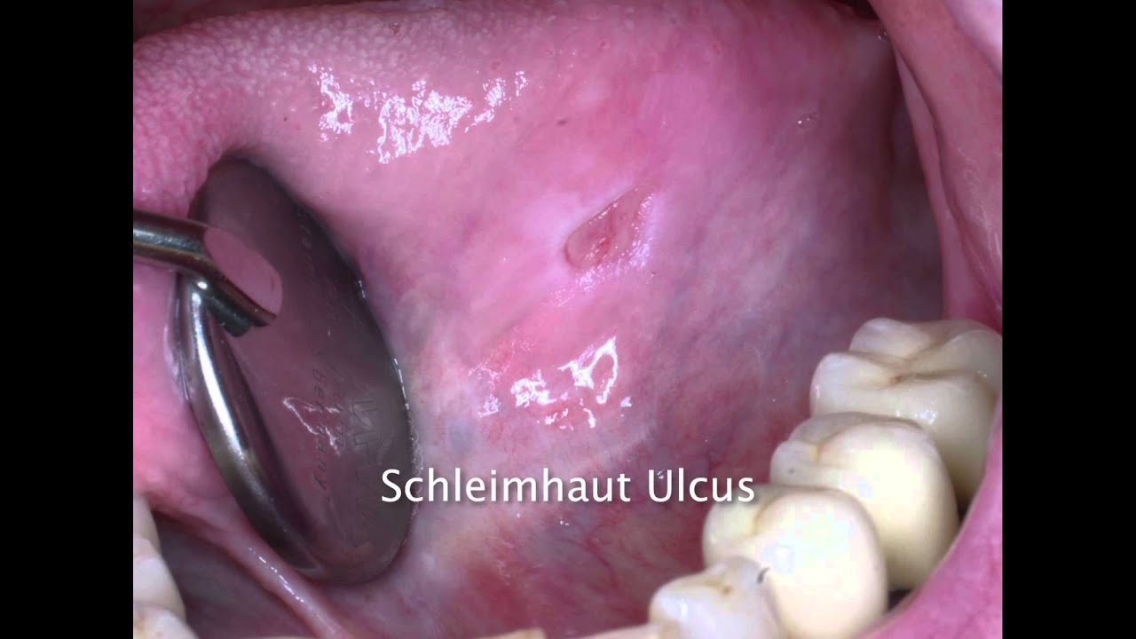 Fibrom im mund