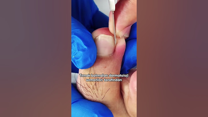 Tırnak Batması ve Tedavisi 🦶