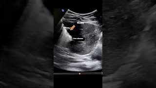 Liver abscess drainage - Ultrasound guided #radiology #usg #surgery #mri #science  #anatomy
