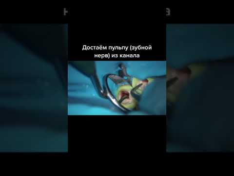 Достаем зубной нерв #shorts