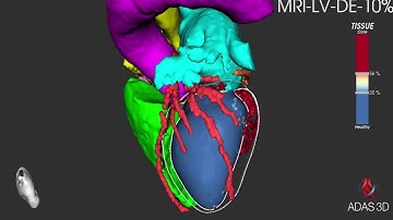 Cardiac 3D model using CTA and MRI information