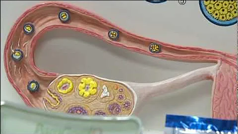 Tubal Reversal - Bernard Rosenfeld, MD Birth Control