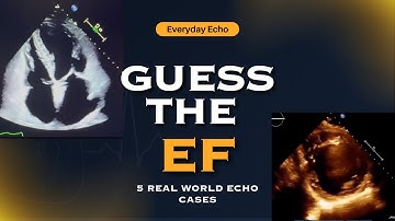 Guess the EF: 5 Real Echo Cases to Test Your Echocardiography Skills (Visual Ejection Fraction)