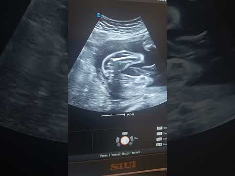 نوع الجنين بالسونار  دكتور إيهاب طنطاوي