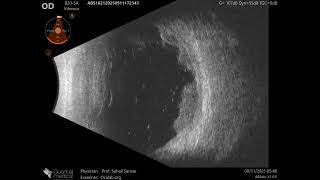 20 MHz Annular Ophthalmic Ultrasound ABSolu, Retina shows multiple hemorrhagic detachment along infe