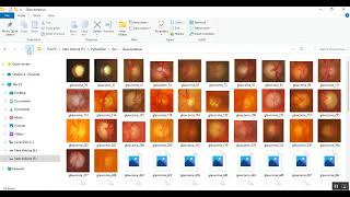 Glaucoma Disease Detection Using Deep Learning