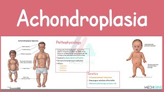 Achondroplasia | Causes, Pathophysiology, Symptoms, Diagnosis, and Management Simplified