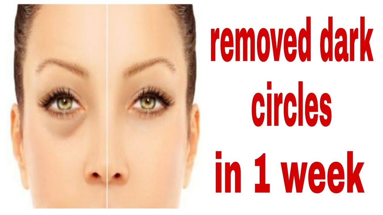 How to Remove dark circles with 1 ingredient and 10 days remove 100