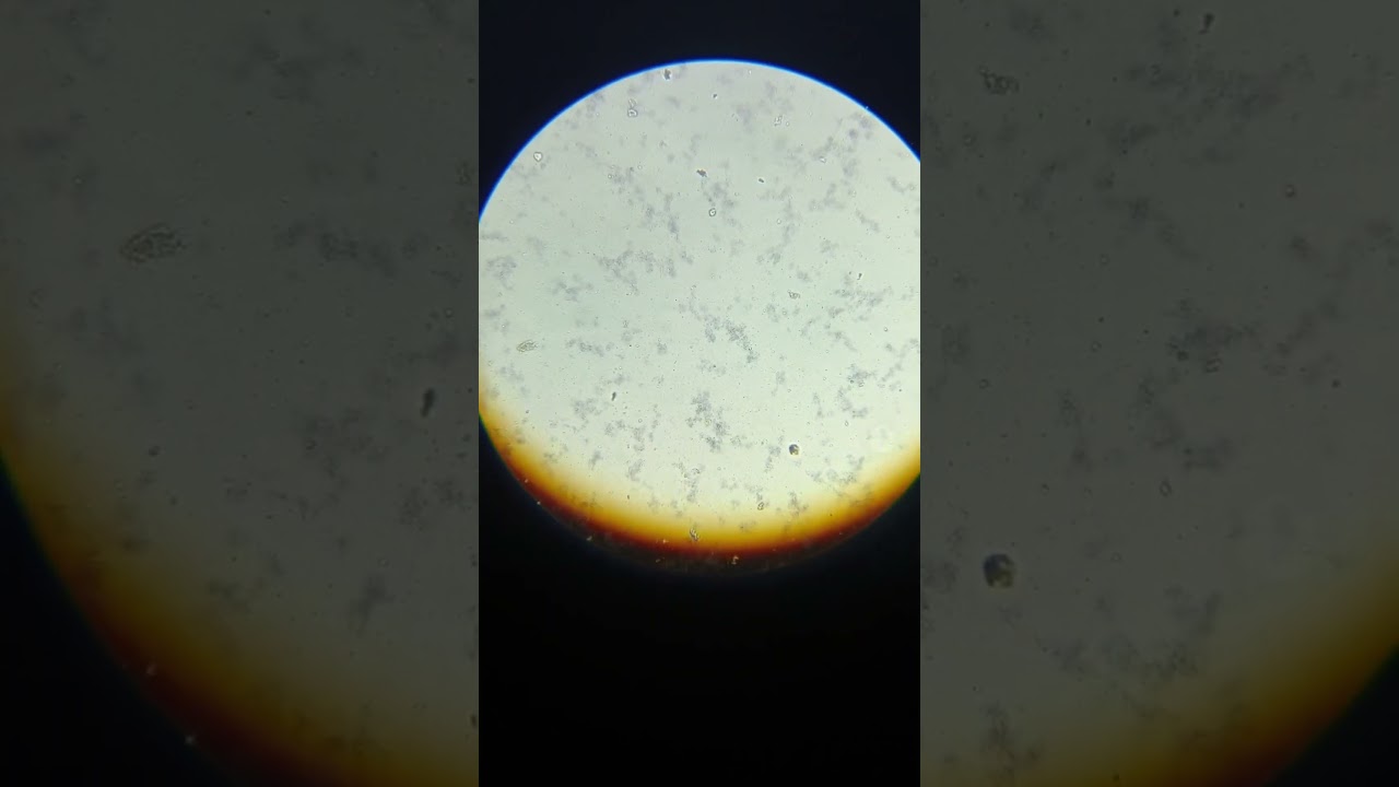 Widal test positive / widal T H positive 1/80 agglutination microscopic view // 